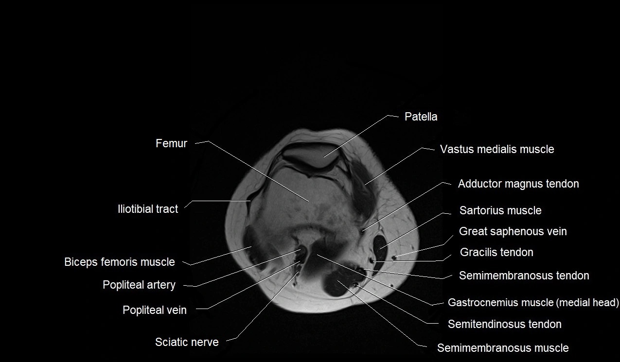 MRI thigh cross sectional anatomy image 54.webp